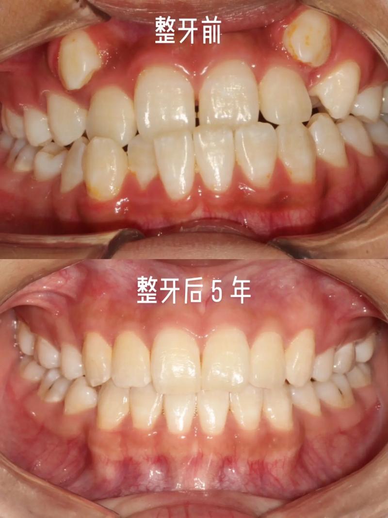 虎牙是乳牙怎么正畸-图3