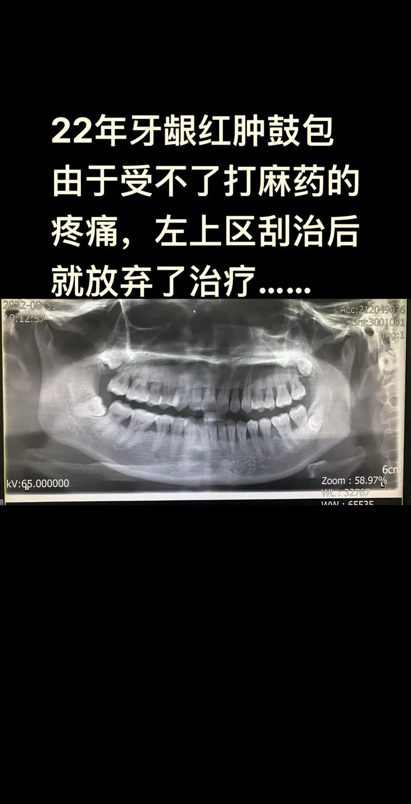 牙槽骨植骨不翻瓣，效果与优势究竟如何？-图1