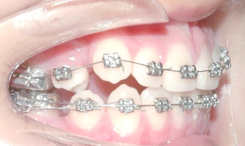 正畸托槽需要调整吗-图1