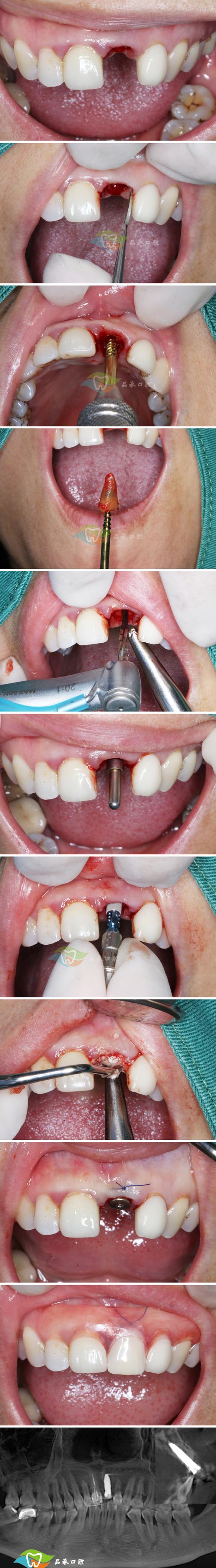 植牙中的即拔即种-图2 植牙中的即拔即种-图2