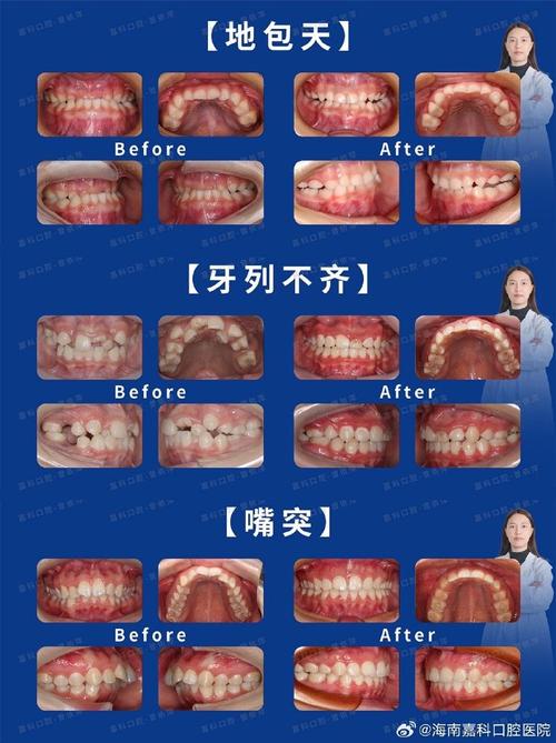 口腔正畸科包含哪些-图3