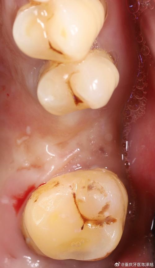 植体邻牙有牙髓炎-图3