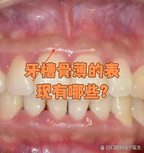 牙槽骨薄正畸植骨-图1 牙槽骨薄正畸植骨-图1