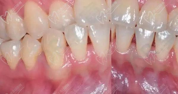 牙槽骨薄正畸植骨-图3 牙槽骨薄正畸植骨-图3