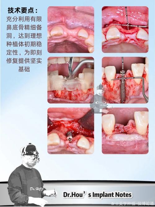 什么叫种牙植骨术-图1