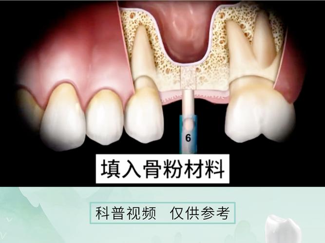 什么叫种牙植骨术-图3