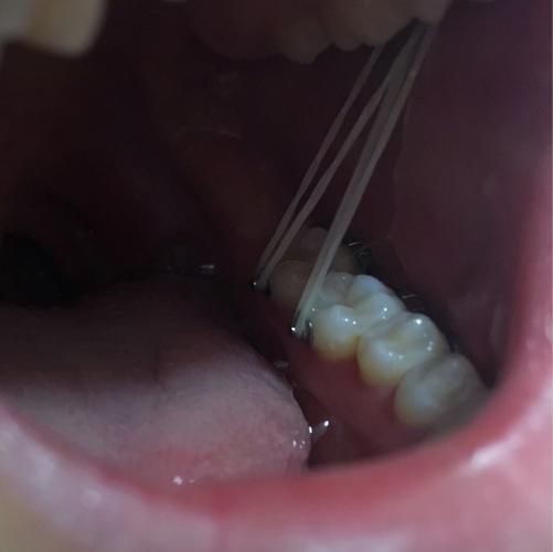 牙正畸皮筋舌头磨破-图3 牙正畸皮筋舌头磨破-图3
