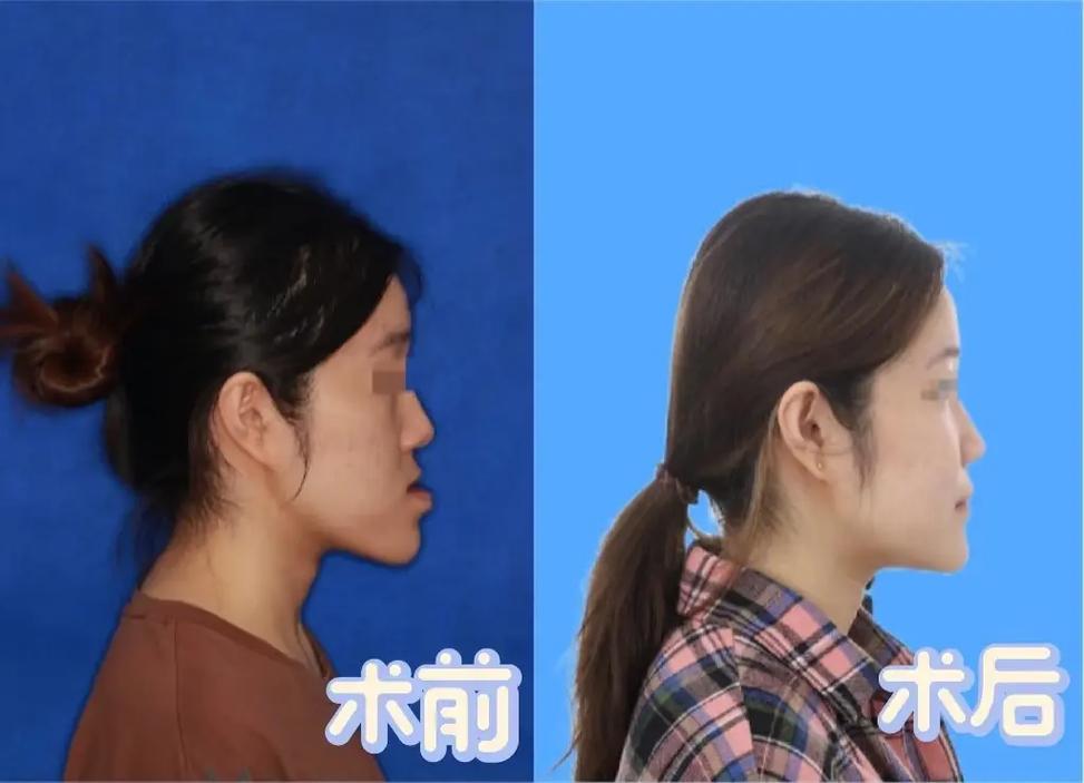 正畸 安氏三 案例-图2 正畸 安氏三 案例-图2