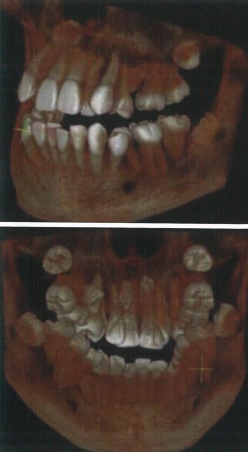 根尖发育发育与正畸-图3