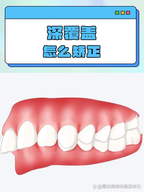 口腔正畸中覆盖具体指什么?-图1 口腔正畸中覆盖具体指什么?-图1