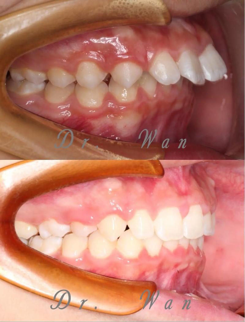 口腔正畸中覆盖具体指什么?-图2 口腔正畸中覆盖具体指什么?-图2