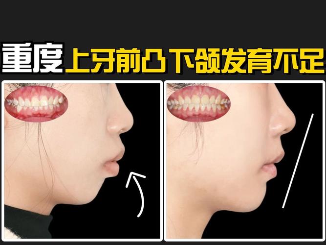 正畸牙齿 鼻梁变高-图2