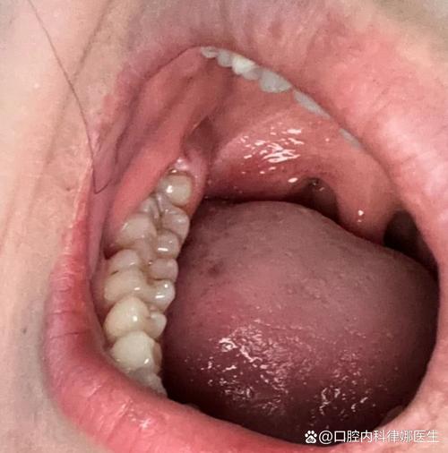 奥齿泰只植牙过敏-图1 奥齿泰只植牙过敏-图1