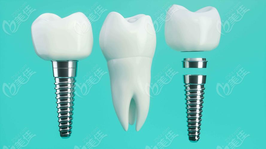 奥齿泰只植牙过敏-图2 奥齿泰只植牙过敏-图2