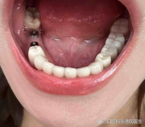 保定市二医院植牙效果如何?价格贵不贵?技术靠谱吗?-图1 保定市二医院植牙效果如何?价格贵不贵?技术靠谱吗?-图1