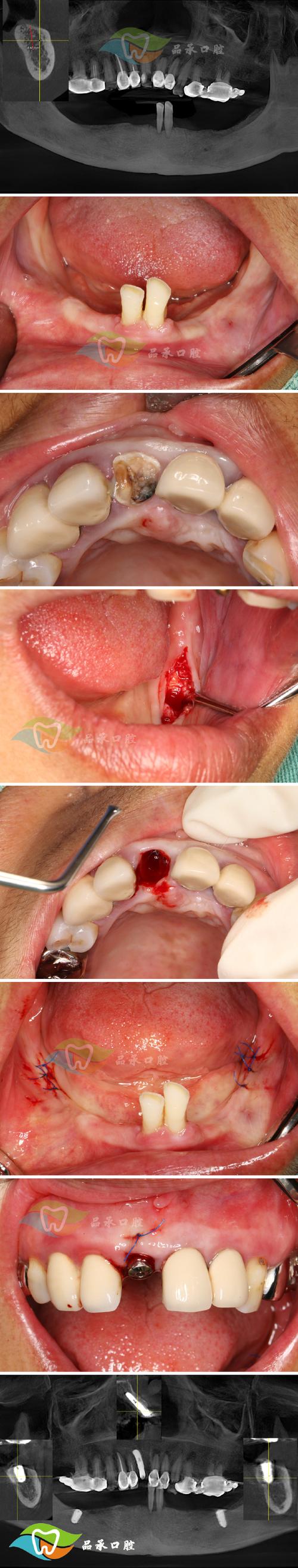 保定市二医院植牙效果如何?价格贵不贵?技术靠谱吗?-图3 保定市二医院植牙效果如何?价格贵不贵?技术靠谱吗?-图3