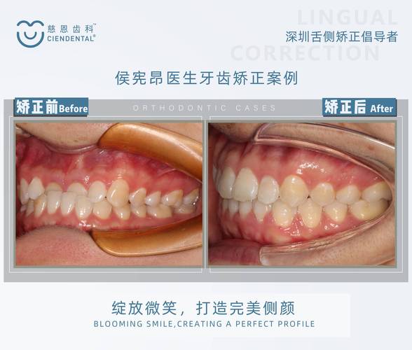 徐国强口腔lh正畸-图2 徐国强口腔lh正畸-图2