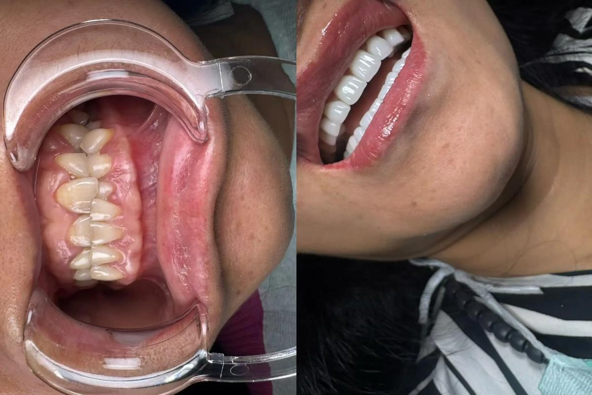 带全植牙会口臭吗-图1 带全植牙会口臭吗-图1