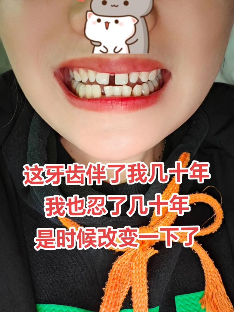 带全植牙会口臭吗-图3 带全植牙会口臭吗-图3