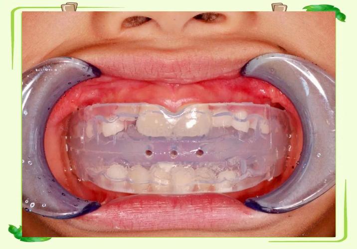 功能诱导与正畸治疗,如何选择早期矫治方案?-图1 功能诱导与正畸治疗,如何选择早期矫治方案?-图1