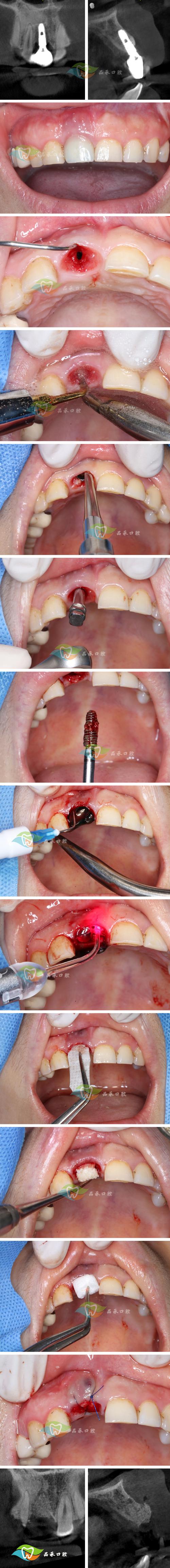 植牙后牙根晃动,是正常现象吗?该如何应对?-图3 植牙后牙根晃动,是正常现象吗?该如何应对?-图3