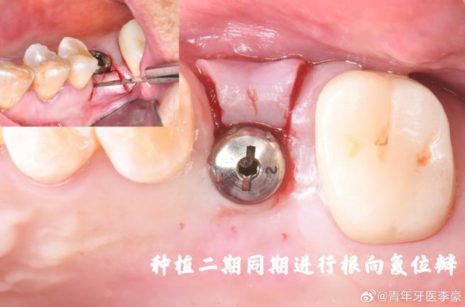 珠海公立医院植牙效果如何?价格贵不贵?靠谱吗?-图1 珠海公立医院植牙效果如何?价格贵不贵?靠谱吗?-图1