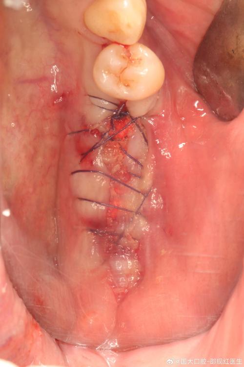 种植牙拔牙时植骨-图2 种植牙拔牙时植骨-图2