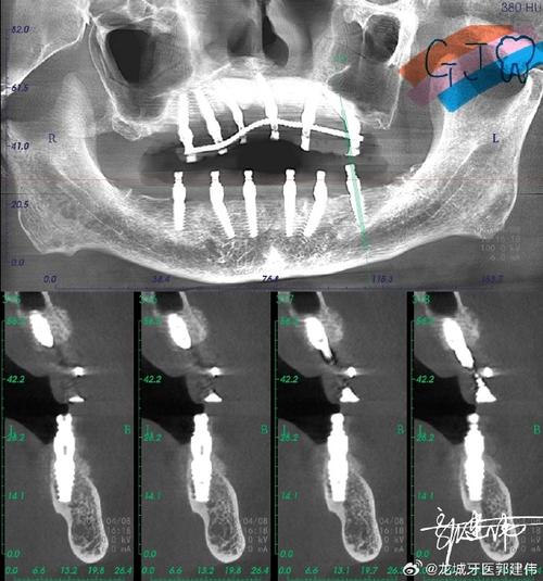 种植牙植骨的骨头从哪来?安全可靠吗?-图2 种植牙植骨的骨头从哪来?安全可靠吗?-图2