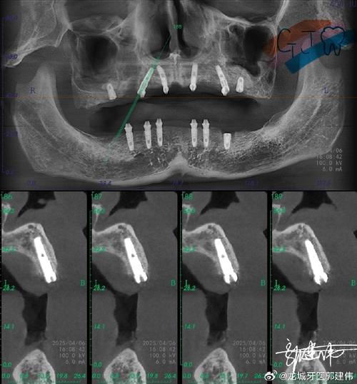 种植牙植骨的骨头从哪来?安全可靠吗?-图3 种植牙植骨的骨头从哪来?安全可靠吗?-图3