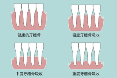 正畸牙根吸收的研究-图1 正畸牙根吸收的研究-图1