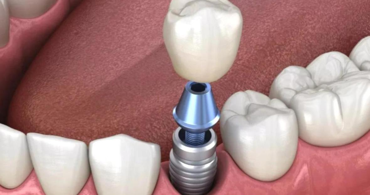 种植牙要植软组织-图1 种植牙要植软组织-图1