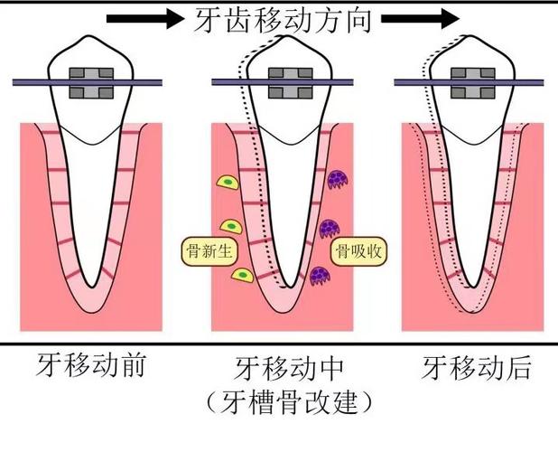 正畸功能矫治的原理-图1