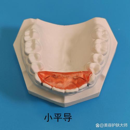 正畸导板的矫正特点-图3