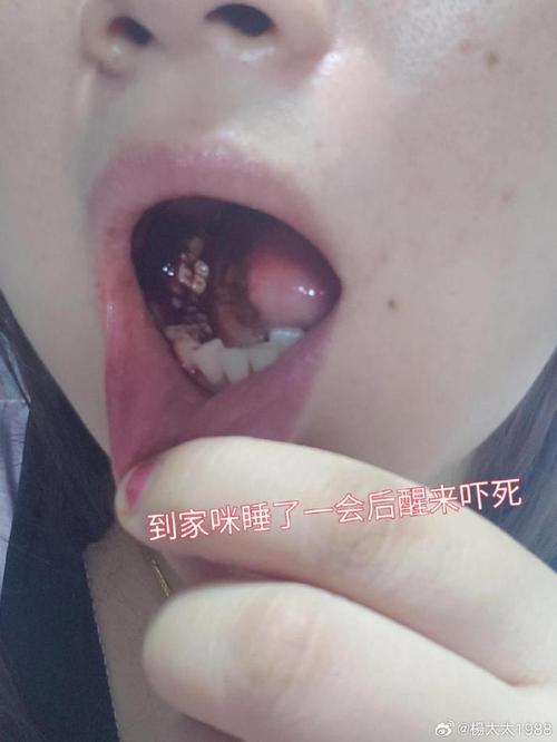 种牙植骨粉出来了-图2 种牙植骨粉出来了-图2