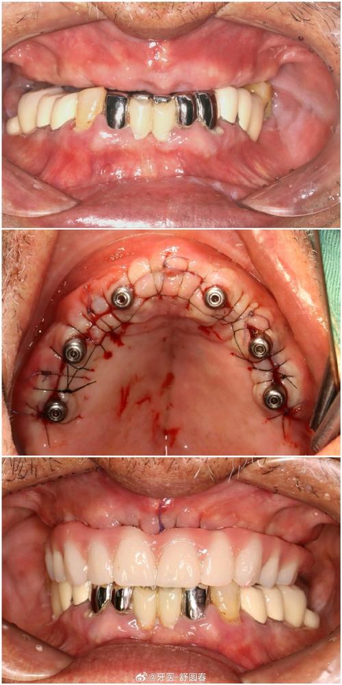 植骨的即刻种植牙，效果真的比传统种植更稳定吗？-图3