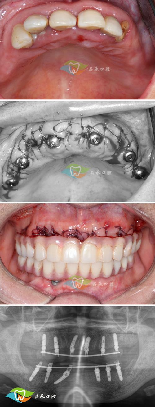 正畸刺激下颌骨生长-图2