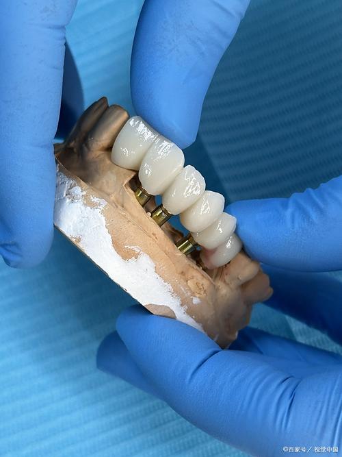 dio植牙怎么样-图3