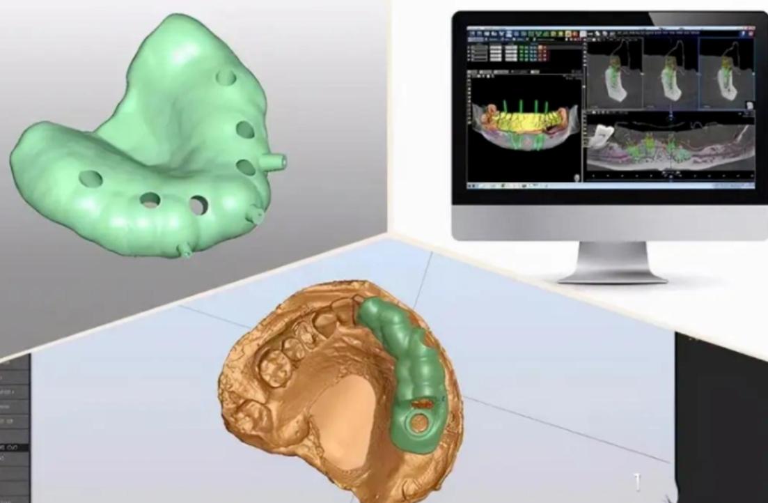 全数字话导航植牙-图2 全数字话导航植牙-图2