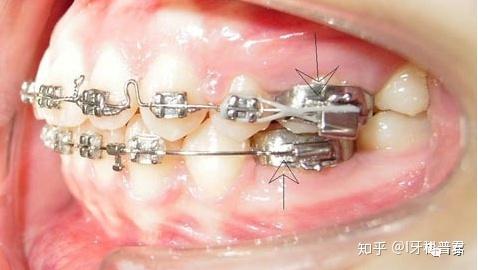 正畸带环现在还用吗-图2