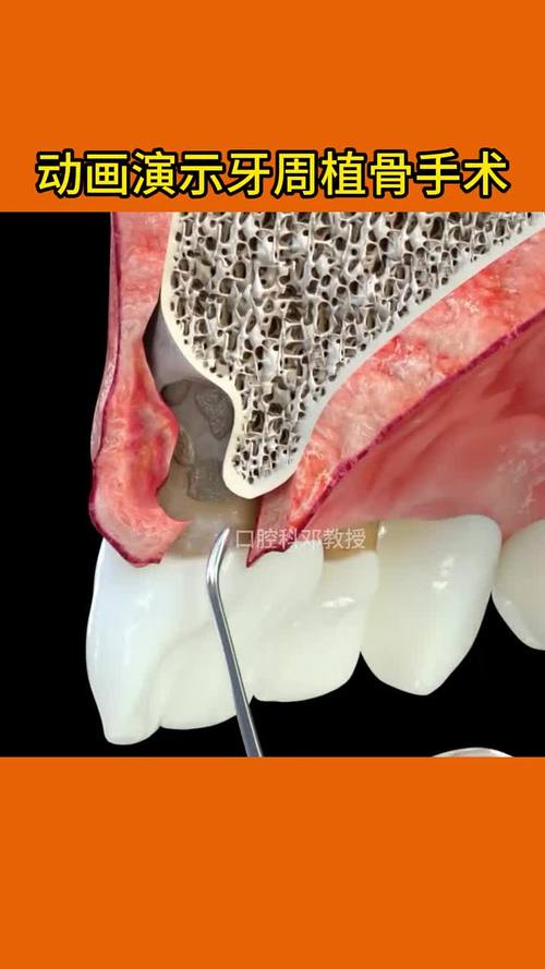 牙周植骨手术效果-图1 牙周植骨手术效果-图1