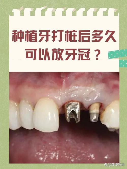 植牙多久可以装冠-图3