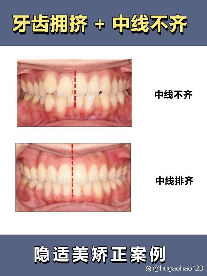 正畸 中线什么意思-图1 正畸 中线什么意思-图1