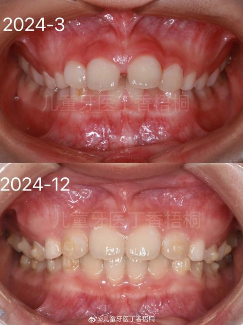 10岁孩子牙齿正畸-图2