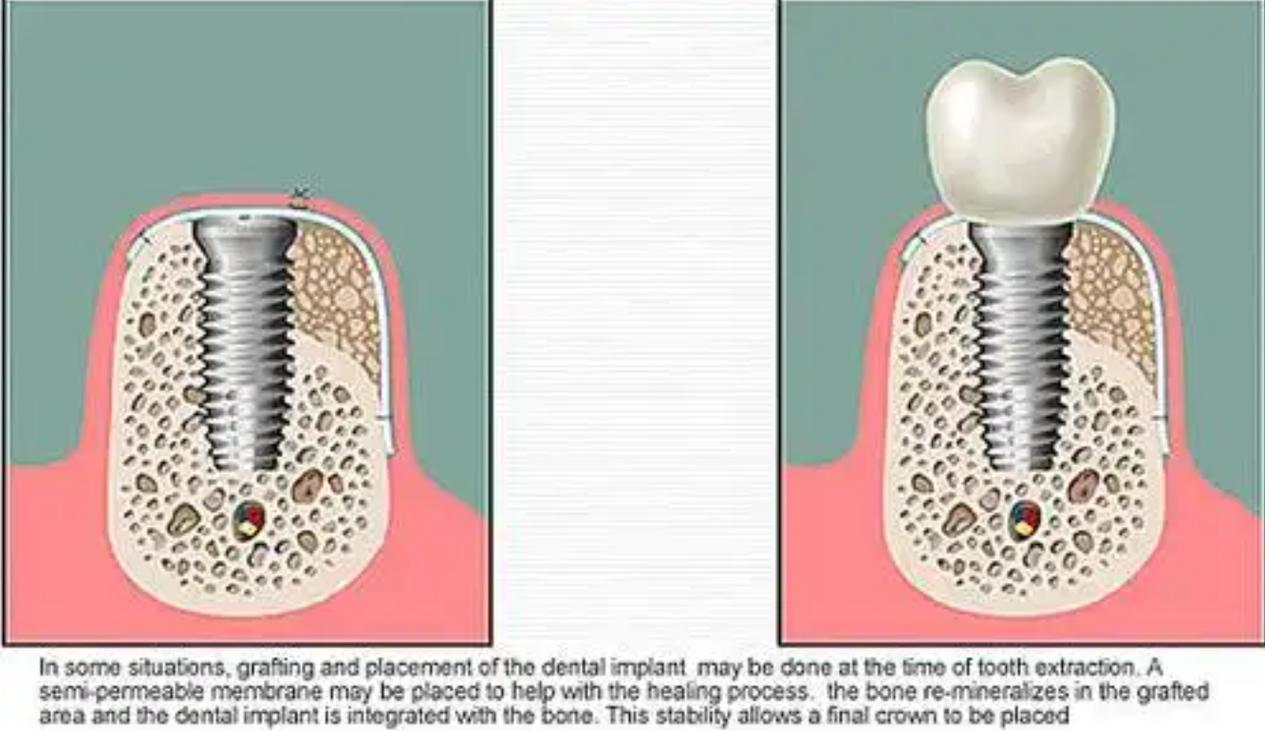 种植牙植骨后疼痛一般会持续几天?-图1 种植牙植骨后疼痛一般会持续几天?-图1