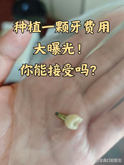 植牙 基台要钱吗-图2