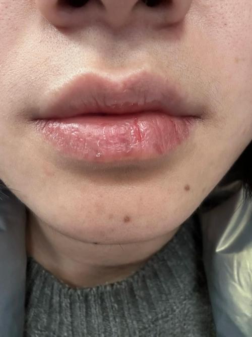 植牙骨后嘴巴干燥是什么原因？该如何有效缓解？-图1