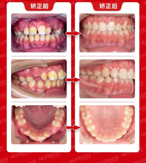 正畸矫正凸嘴，究竟能改善几毫米？-图1