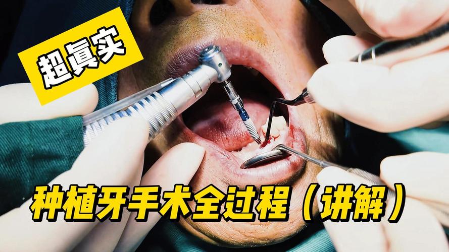 口腔植牙手术视频-图2