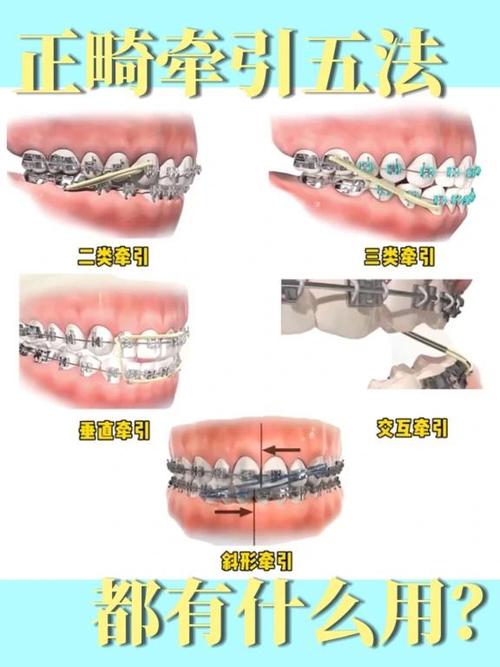 正畸4 6矫治技术是什么?效果与传统有何不同?-图3 正畸4 6矫治技术是什么?效果与传统有何不同?-图3