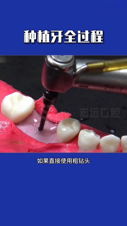 最新植牙技术视频-图1 最新植牙技术视频-图1
